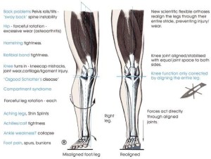 orthotics alignment